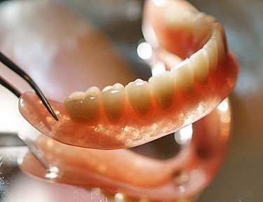 5 Advantages of Getting Implant Overdentures