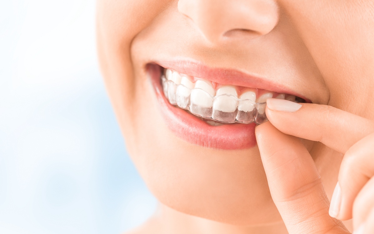 Clear Aligners Market: Trends, Drivers, and Challenges in the Orthodontic Industry