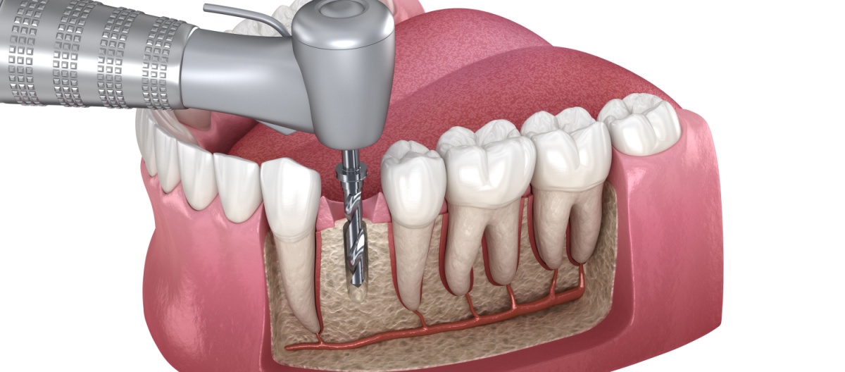 Root Canal Treatment Christchurch - A Clinical Intervention