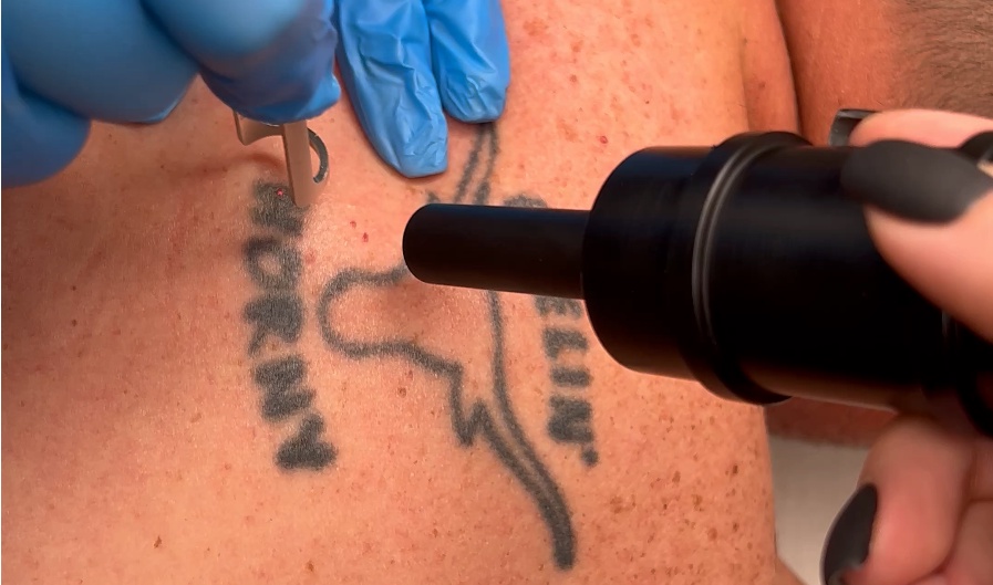 Say Goodbye to Your Tattoo with These Effective Removal Techniques