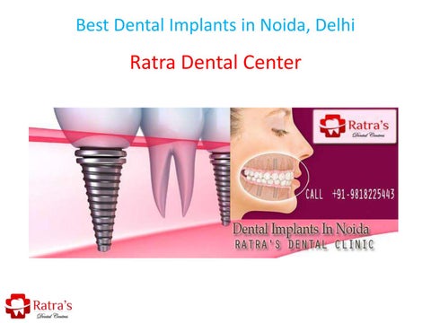 Best Dental Implant Clinic in Noida: A Complete Guide