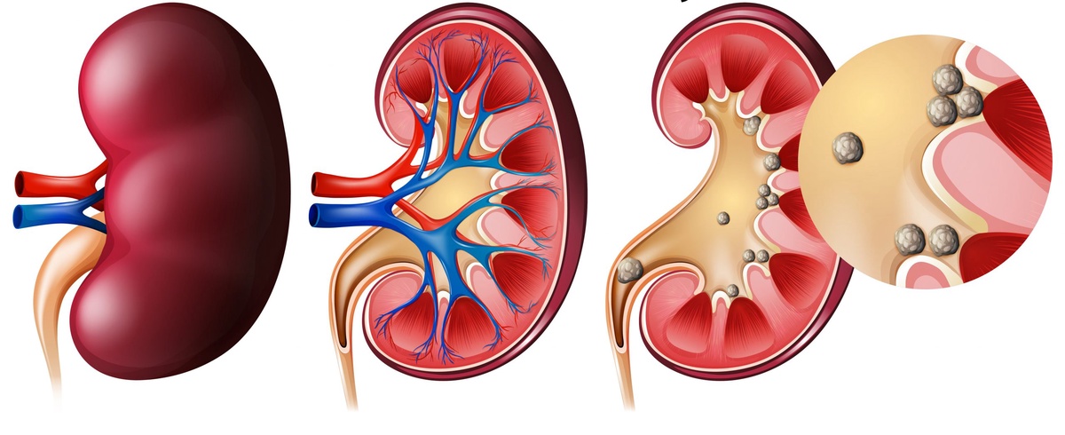 Effective Treatment Solutions for Gallstones and Kidney Stones