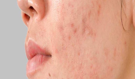 What To Do If Someone Has Acne Scars