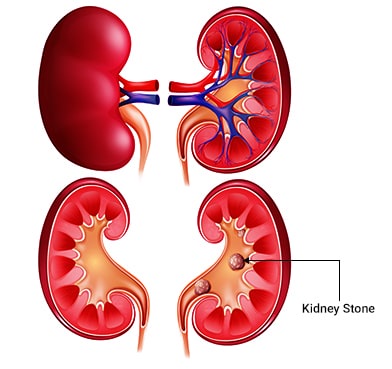 Get Kidney Stones Removed with PCNL Surgery