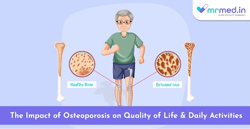 The Impact of Osteoporosis on Quality of Life and Daily Activities