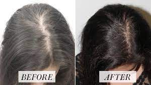 Hair Loss Beware! Discover the Magic of Hair Transplantation in Andheri West