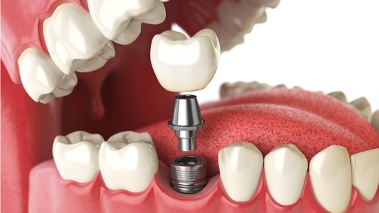 Single Tooth Implant Cost in Delhi: Investing in Your Confident Smile