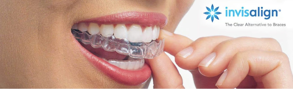 Want to align teeth with discretion? Know what to expect from the Invisalign journey