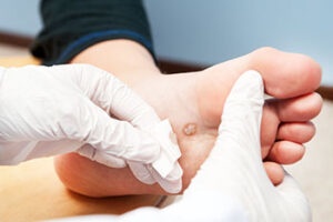Your Feet Deserve Relief from Plantar Wart Removal Today