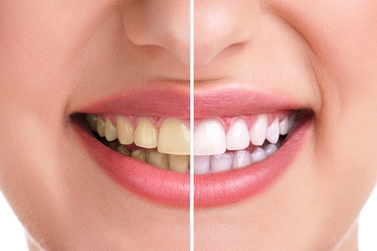 Know The Benefits Of People Getting Tooth Whitening Treatment
