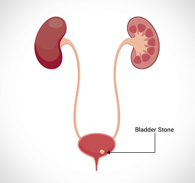 What All You Need To Know About Bladder Stone Removal Surgery