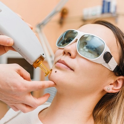 Laser Mole Removal: A Painless and Effective Solution