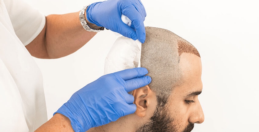 Is Hair Transplant Safe? Risks, Safety and Complications