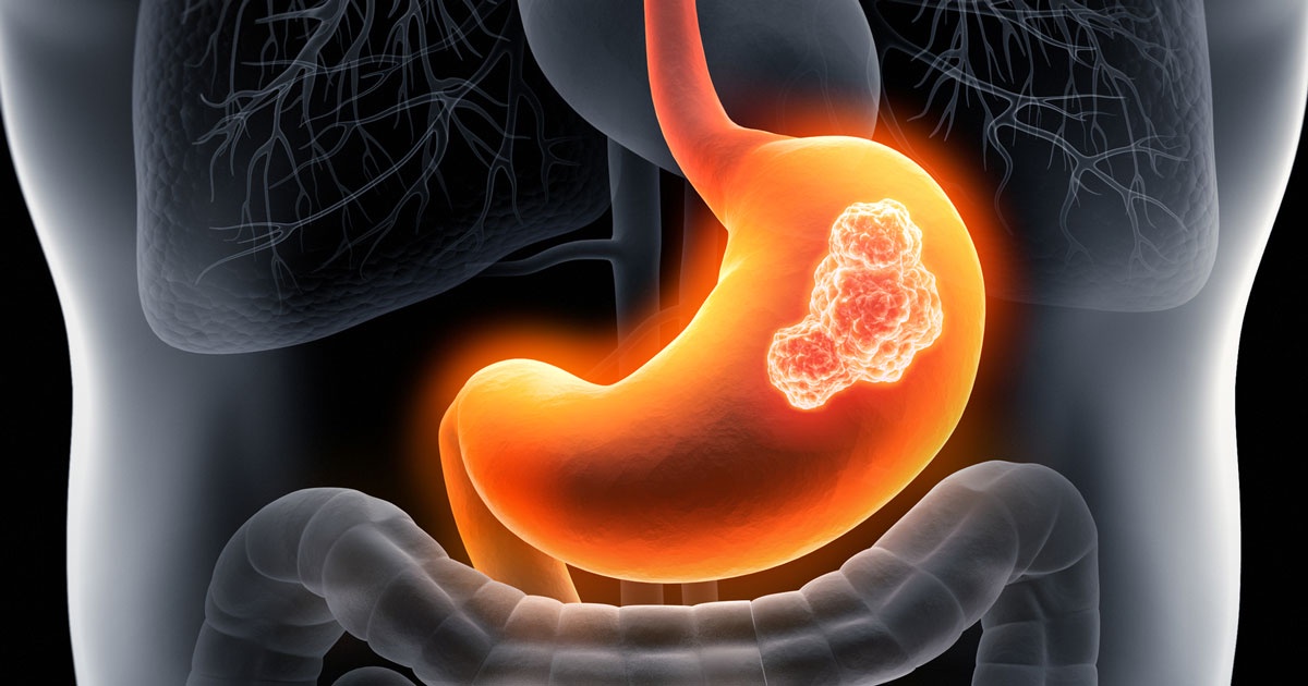 Unveiling the Shadows: Understanding Stomach Cancer
