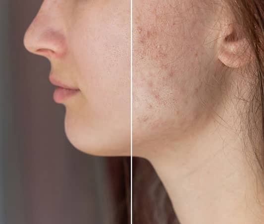 Maximizing Results: The Importance of Multiple Laser Sessions for Acne Scarring