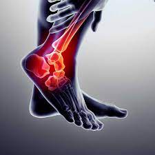 What Information Is Needed About Leg Pain?