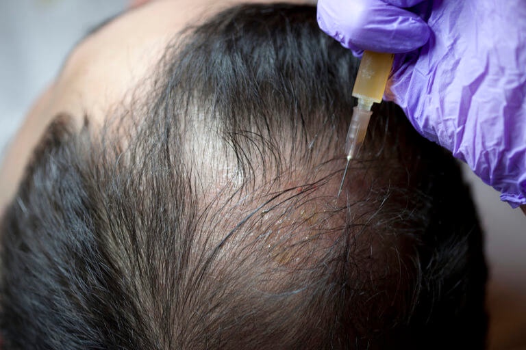Choosing the Right Anesthesia for Your Hair Transplant