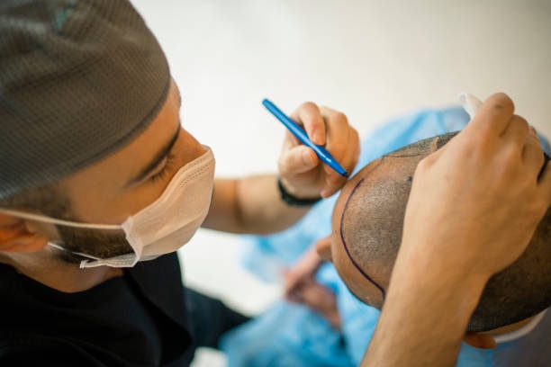 The Essential Qualities of a Hair Transplant Expert: A Comprehensive Guide