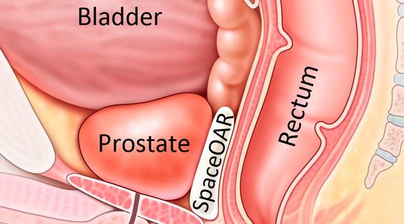 Prostate Gland Treatment - Pflow