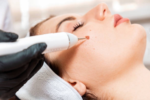 The Future of Flawless Skin: Laser Mole Removal