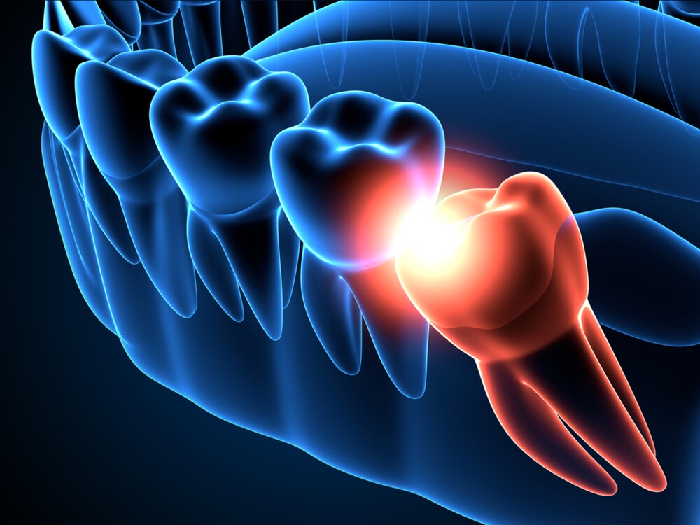 Is Wisdom Tooth Removal Always Necessary?