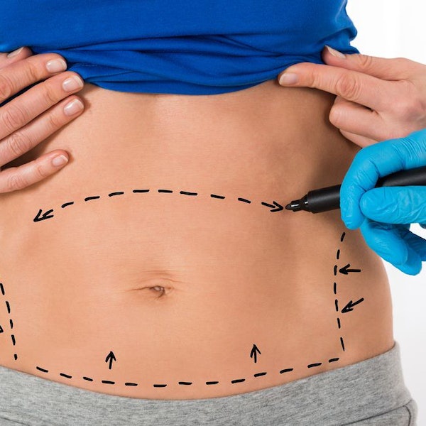Tummy Tuck: Understanding the Procedure and Its Benefits
