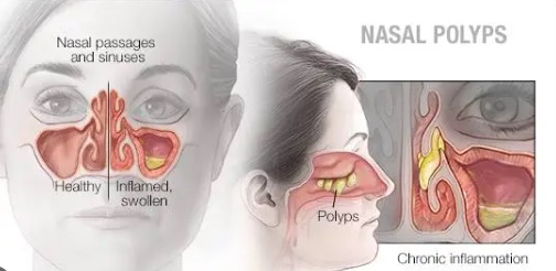Nasal Polyps Treatment Miracle Review - Is it REALLY work for YOU?