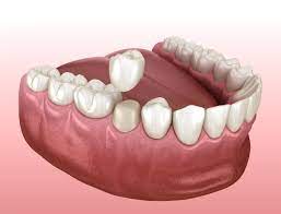 Crowning Glory: Understanding Dental Crowns in Restorative Dentistry