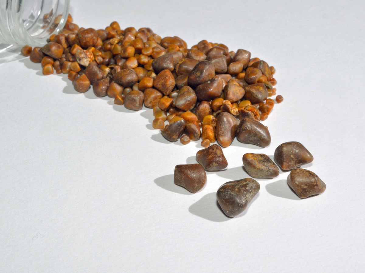 The Emotional Impact: Living with Gallstones and Kidney Stones