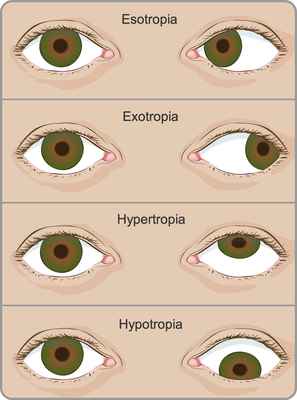 Top Hospital for Squint  Eyes Treatment in Delhi