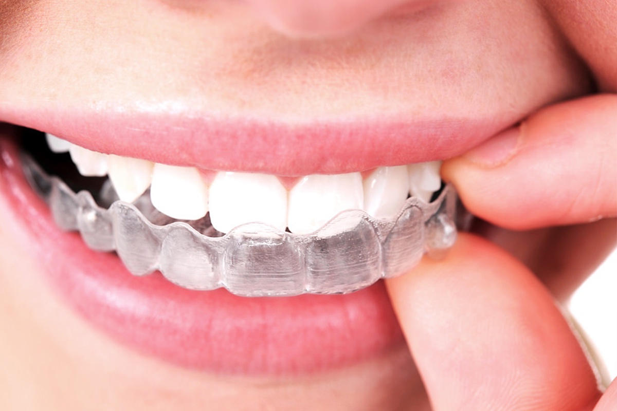 How to Maintain Oral Hygiene While Wearing Braces