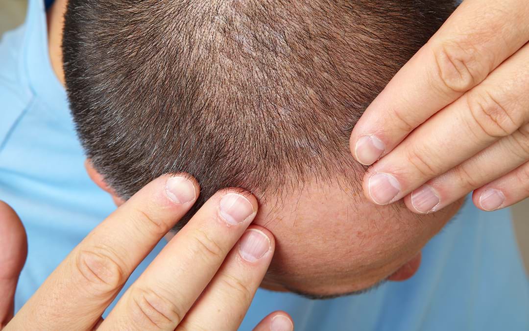 The Impact of Surgeon's Expertise on the Cost of Hair Transplants