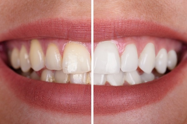 A Comprehensive Guide to Comfortable Teeth Whitening in Dubai