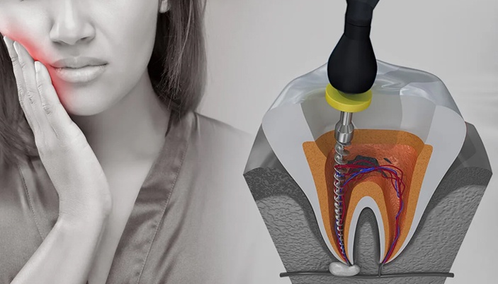 Root Canal Precision: The Artistry of Skilled Endodontists