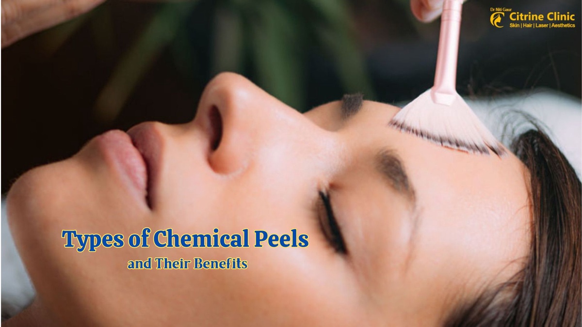 Types of Chemical Peels and Their Benefits
