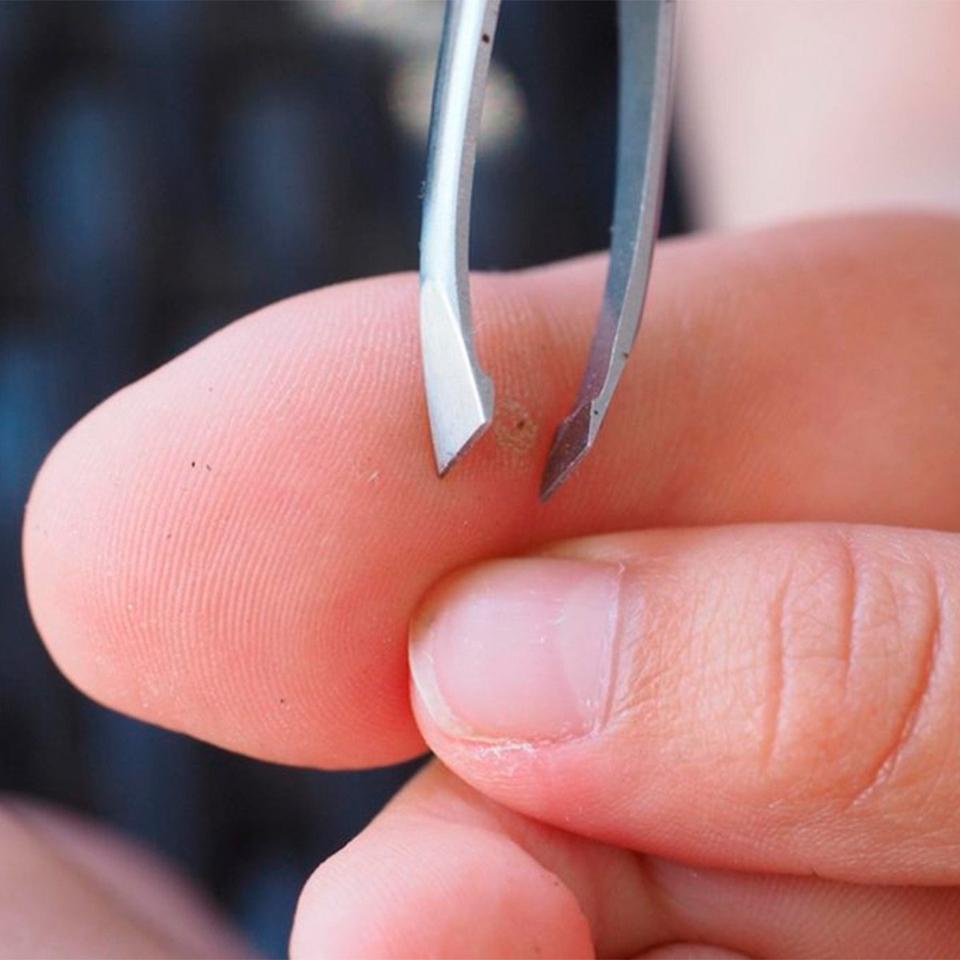 Painless Extraction: How to Get a Splinter Out with Ease