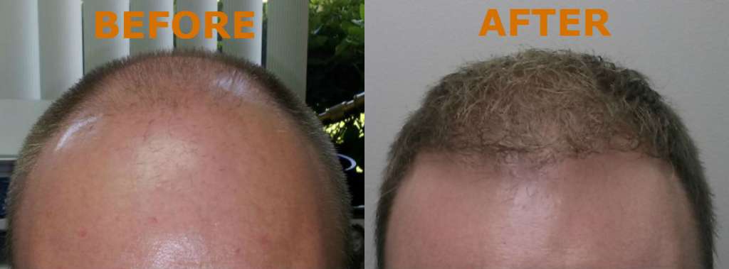 Transform Your Hairline with Neograft Hair Transplant At Toronto Cosmetic Surgery Clinic