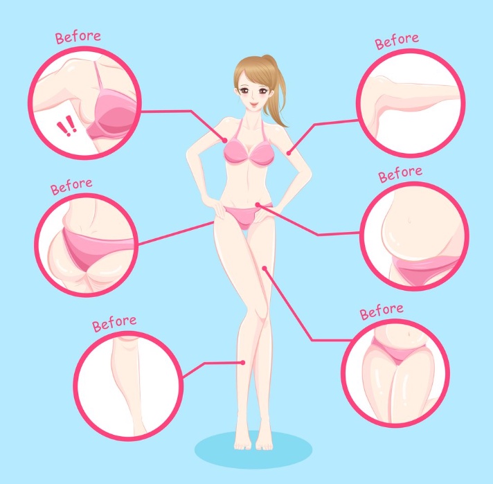 Full-body liposuction is an unexpected operation in comparison to traditional liposuction