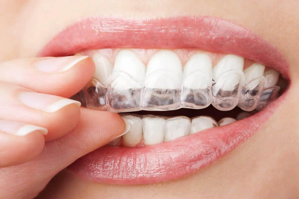 Invisalign Braces for All Ages: Treatment Options in Dubai