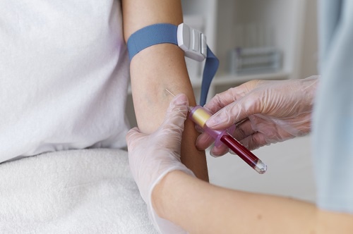 How to Remove Trapped Blood After Sclerotherapy