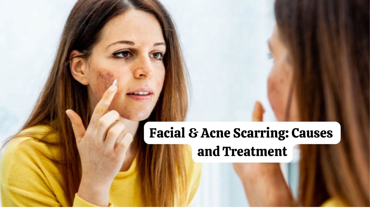 Facial & Acne Scarring: Causes and Treatment