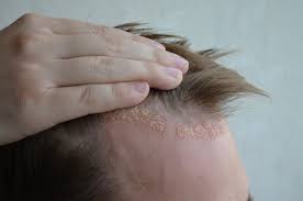 Factors Influencing the Success of a Hair Transplant