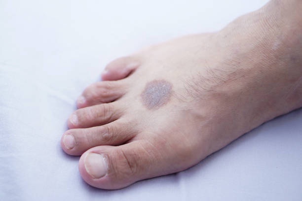 Understanding Ashen Skin: Causes, Symptoms, and Treatment