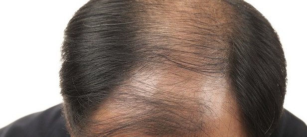 Common Myths About Hair Transplant Surgery