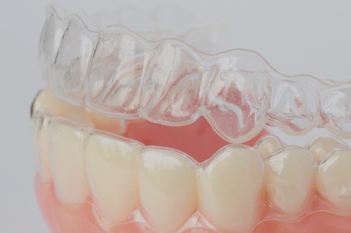 Overlapping Teeth: Expert Care Options in Dubai