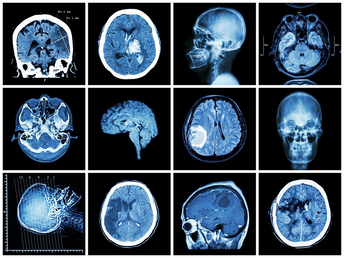 Understanding the Role of Various Scans and Decoding Brain Damage