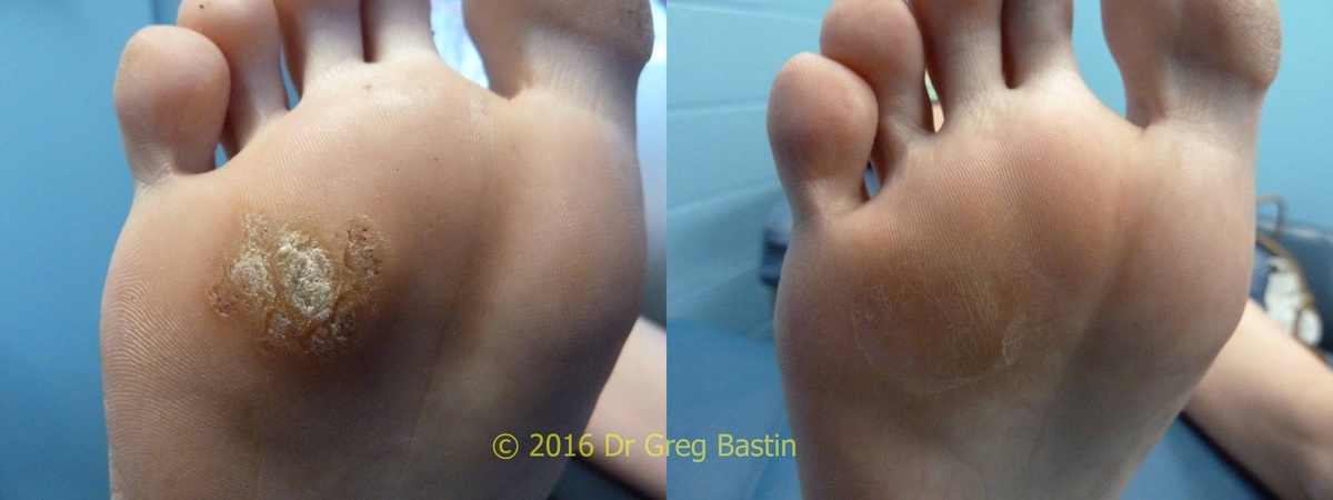 What Should I Know Before Scheduling Wart Removal in Melbourne?