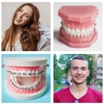 A list of some essential facts about Invisalign Aligners that you should know