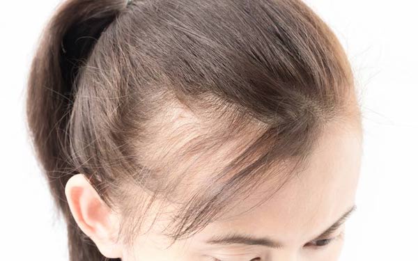 Can medications prevent further hair loss after a transplant?