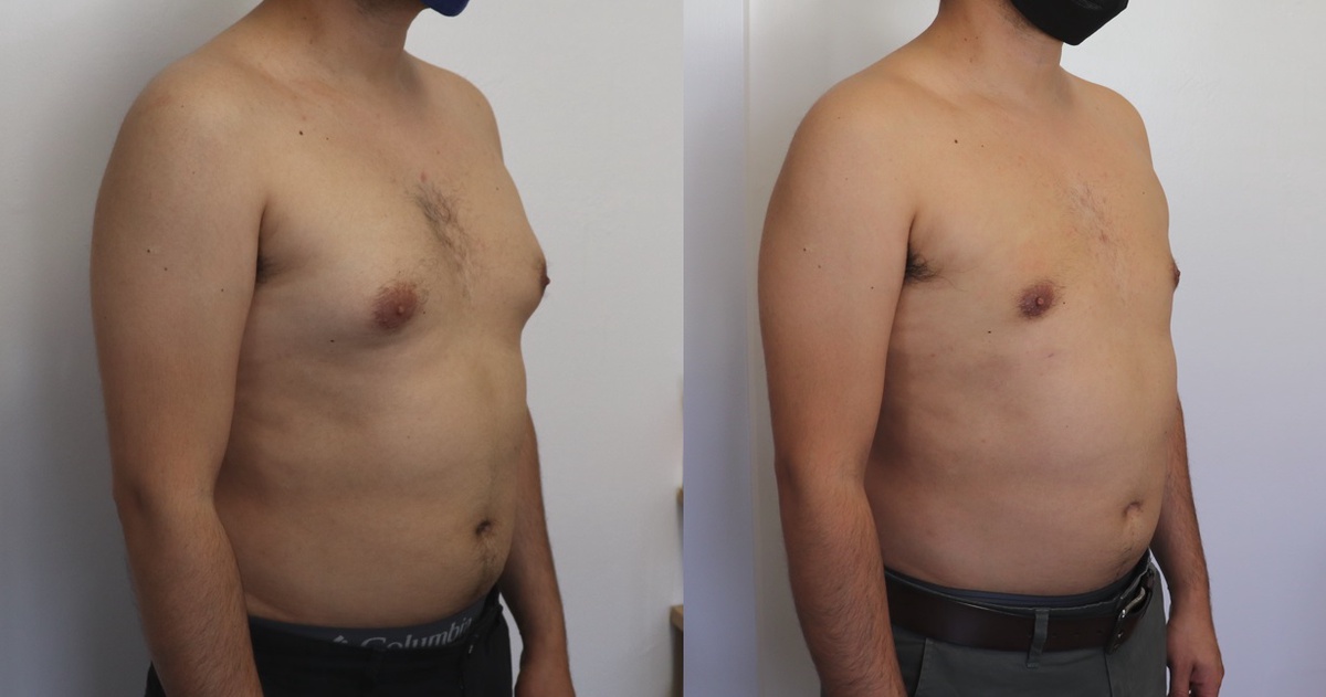 Busting the Myth: Targeted Exercises for Man Boobs – Anshu Mishra’s Fitness Guide